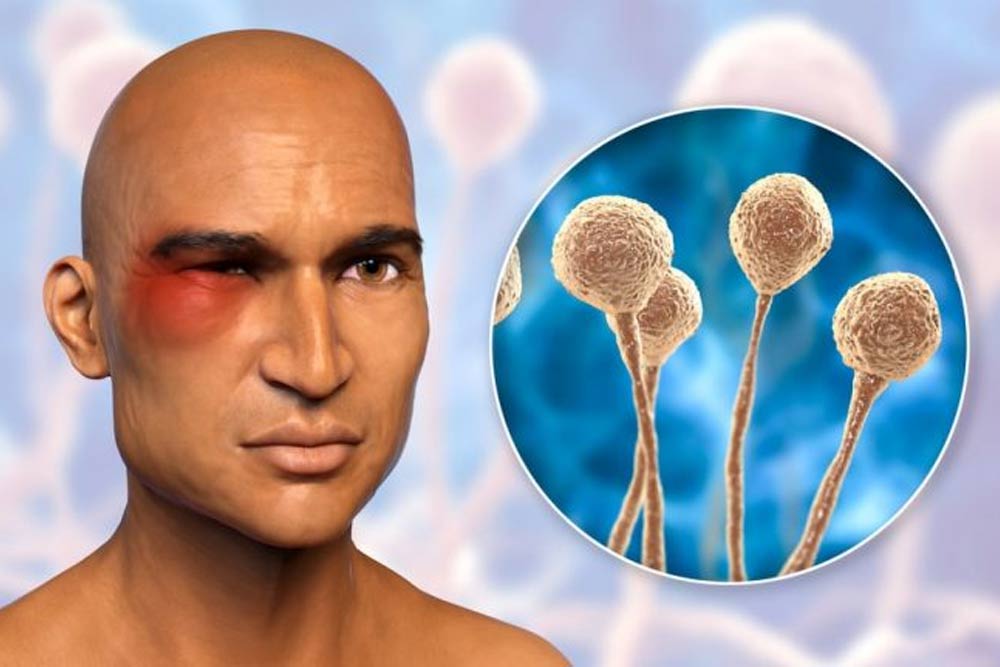 بیماری قارچ سیاه چه علائمی دارد و چگونه درمان میشود؟ | راه های درمان آن