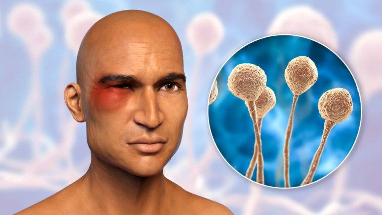 بیماری قارچ سیاه چه علائمی دارد و چگونه درمان میشود؟ | راه های درمان آن