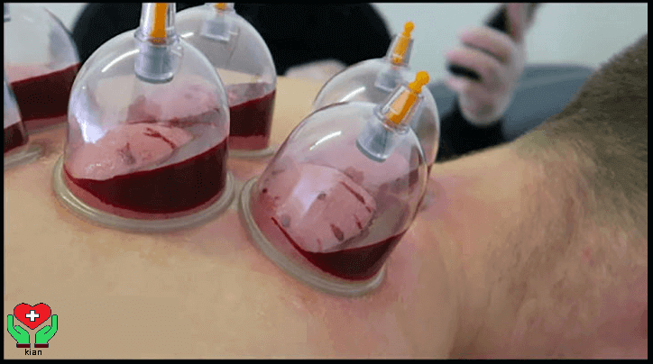 حجامت عام در منزل ، حجامت عام در خانه ، حجامت عام خانگی ، حجامت درمانی ، حجامت در زنان و مردان شبانه روزی و 24 ساعته