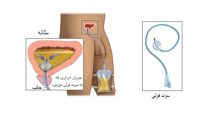 وصل سوند ادرار